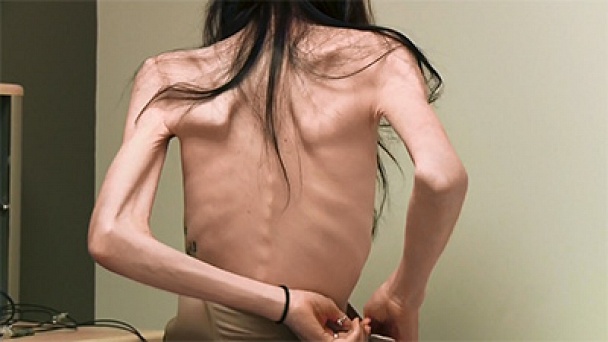 Semi anorexic naked women