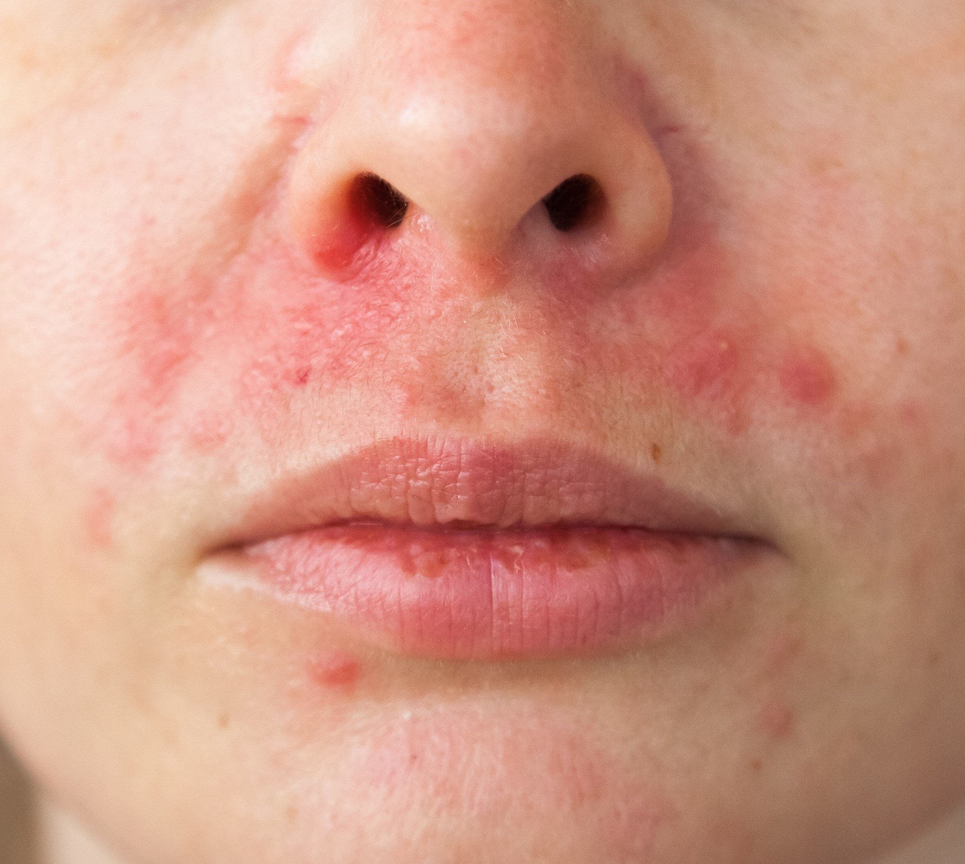 google suggests it could be perioral dermatitis. can anybody suggest me pro...