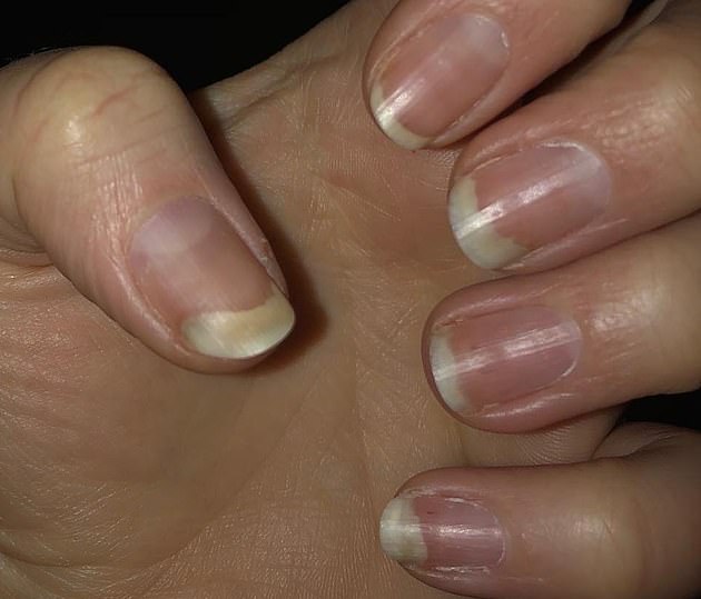 Онихолизис можно покрыть гелем. Травматический онихолизис ногтей. Ногтевой онихолизис онихолизис пластины. Онихолизис и белые пятна.